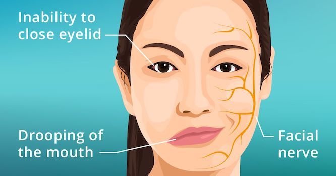 bells-palsy