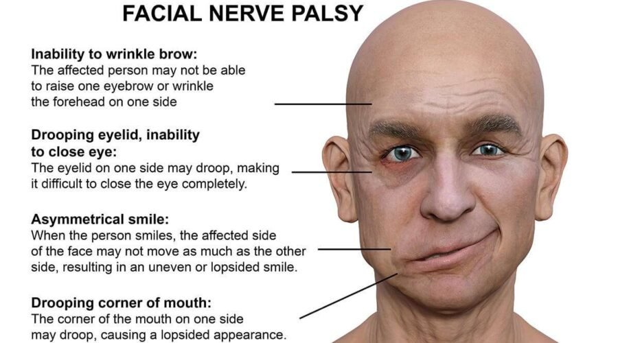 bells-palsy